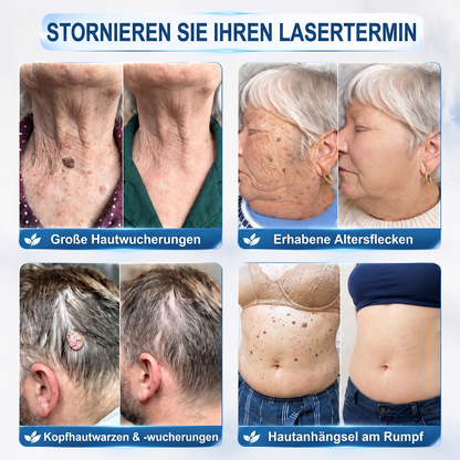 𝐇𝐈𝐒𝐊𝐈𝐍®👩‍⚕️⭐ 7-Tage-Hautmakel- & Hautanhängsel-Entferner Schmerzfreier Rollerball-Stift zur schonenden Entfernung von Hautanhängseln und Hautflecken – narbenfrei
