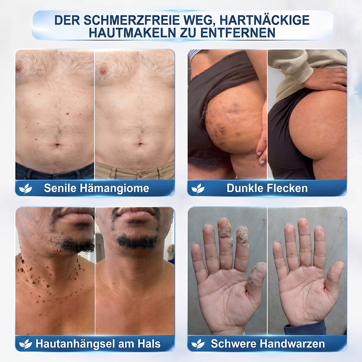 𝐇𝐈𝐒𝐊𝐈𝐍®👩‍⚕️⭐ 7-Tage-Hautmakel- & Hautanhängsel-Entferner Schmerzfreier Rollerball-Stift zur schonenden Entfernung von Hautanhängseln und Hautflecken – narbenfrei