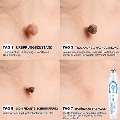 𝐇𝐈𝐒𝐊𝐈𝐍®👩‍⚕️⭐ 7-Tage-Hautmakel- & Hautanhängsel-Entferner Schmerzfreier Rollerball-Stift zur schonenden Entfernung von Hautanhängseln und Hautflecken – narbenfrei